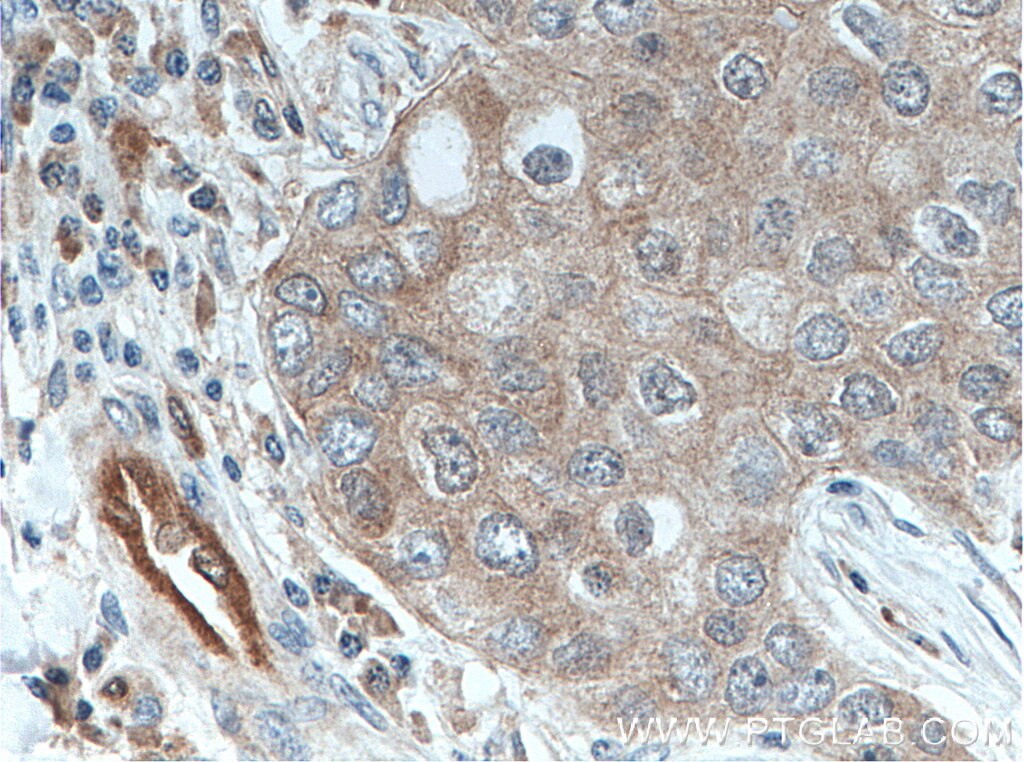 Immunohistochemistry (IHC) staining of human breast cancer tissue using PPA1 Polyclonal antibody (14985-1-AP)