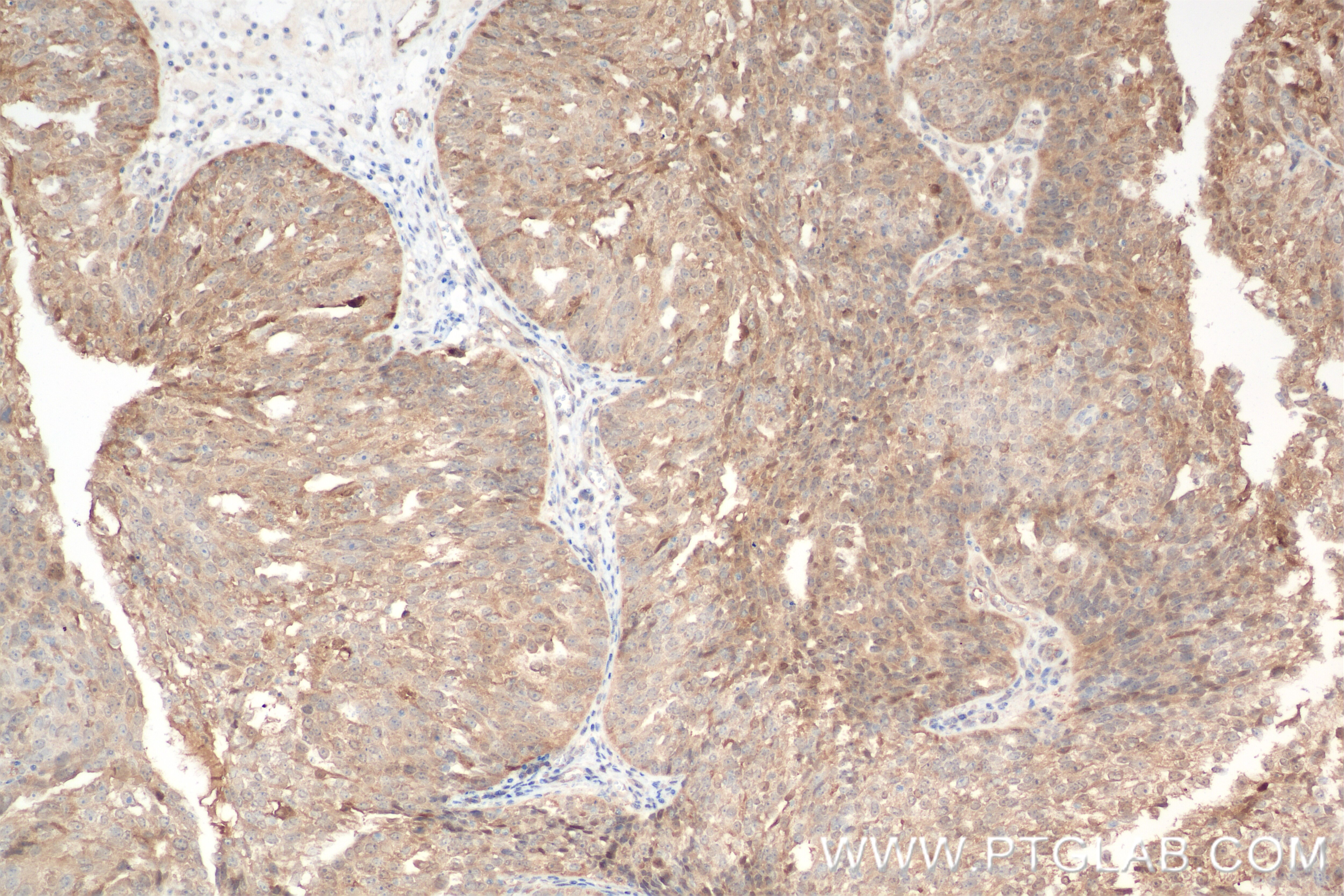 Immunohistochemistry (IHC) staining of human ovary cancer tissue using PPA1 Recombinant antibody (85445-3-RR)