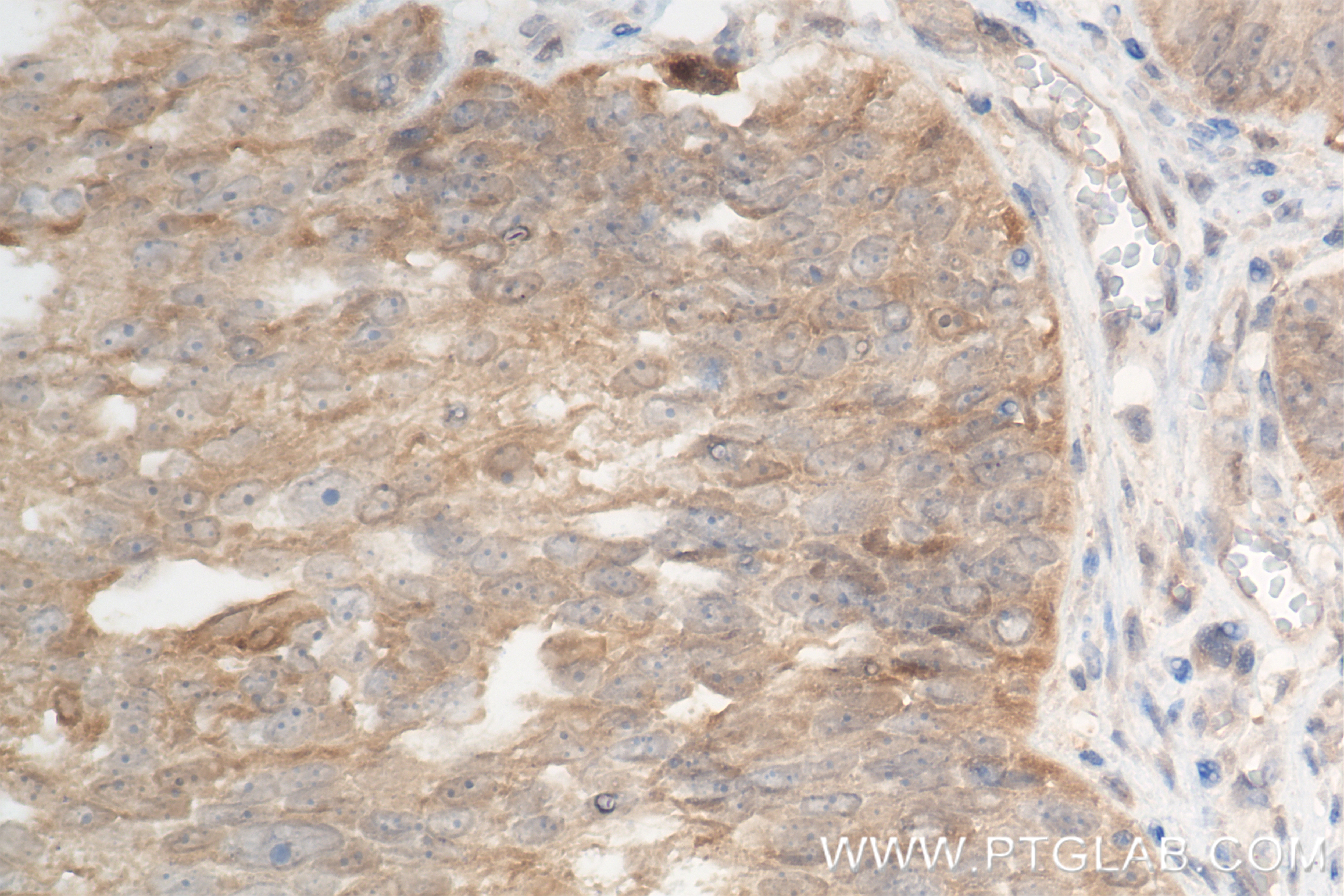 Immunohistochemistry (IHC) staining of human ovary cancer tissue using PPA1 Recombinant antibody (85445-3-RR)
