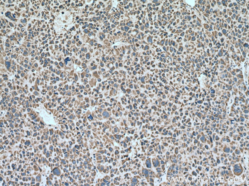 Immunohistochemistry (IHC) staining of human liver cancer tissue using PPA2 Polyclonal antibody (16662-1-AP)