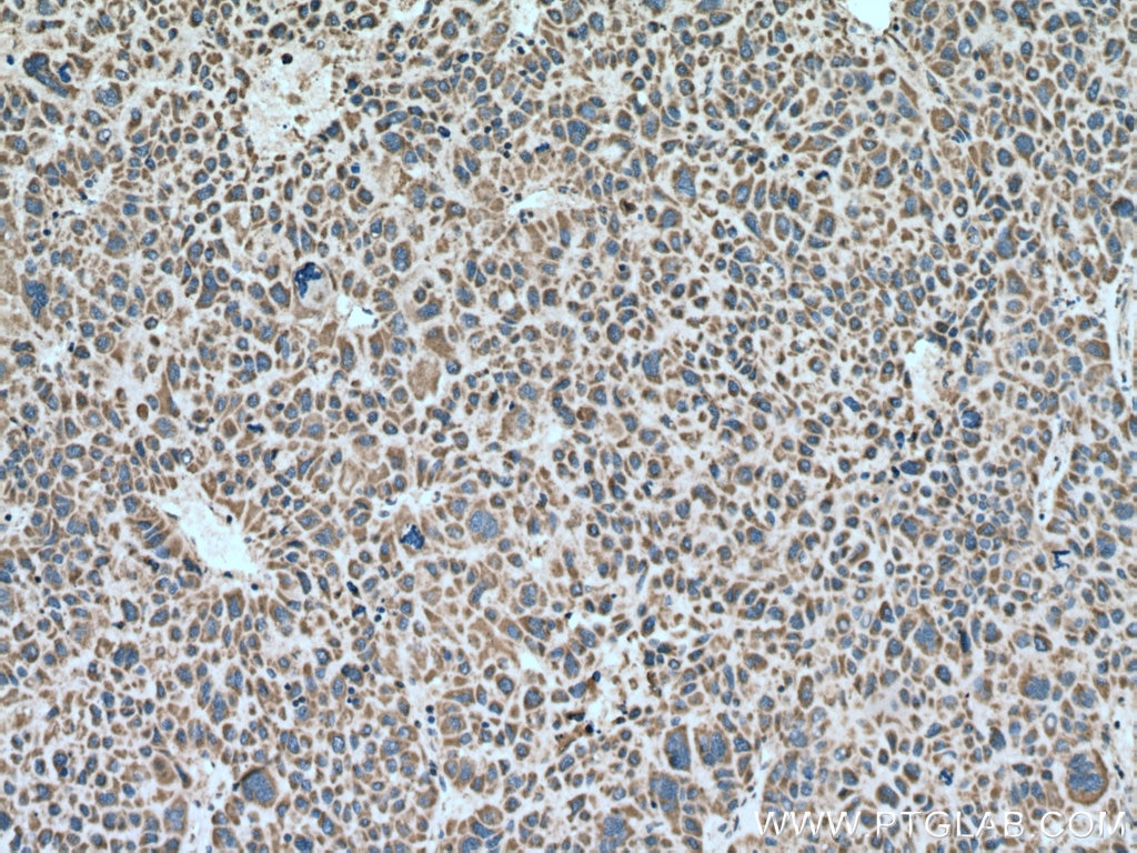 Immunohistochemistry (IHC) staining of human liver cancer tissue using PPA2 Polyclonal antibody (16662-1-AP)