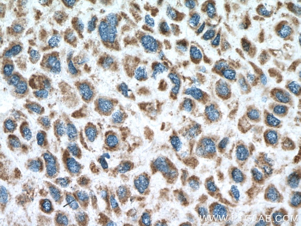Immunohistochemistry (IHC) staining of human liver cancer tissue using PPA2 Polyclonal antibody (16662-1-AP)