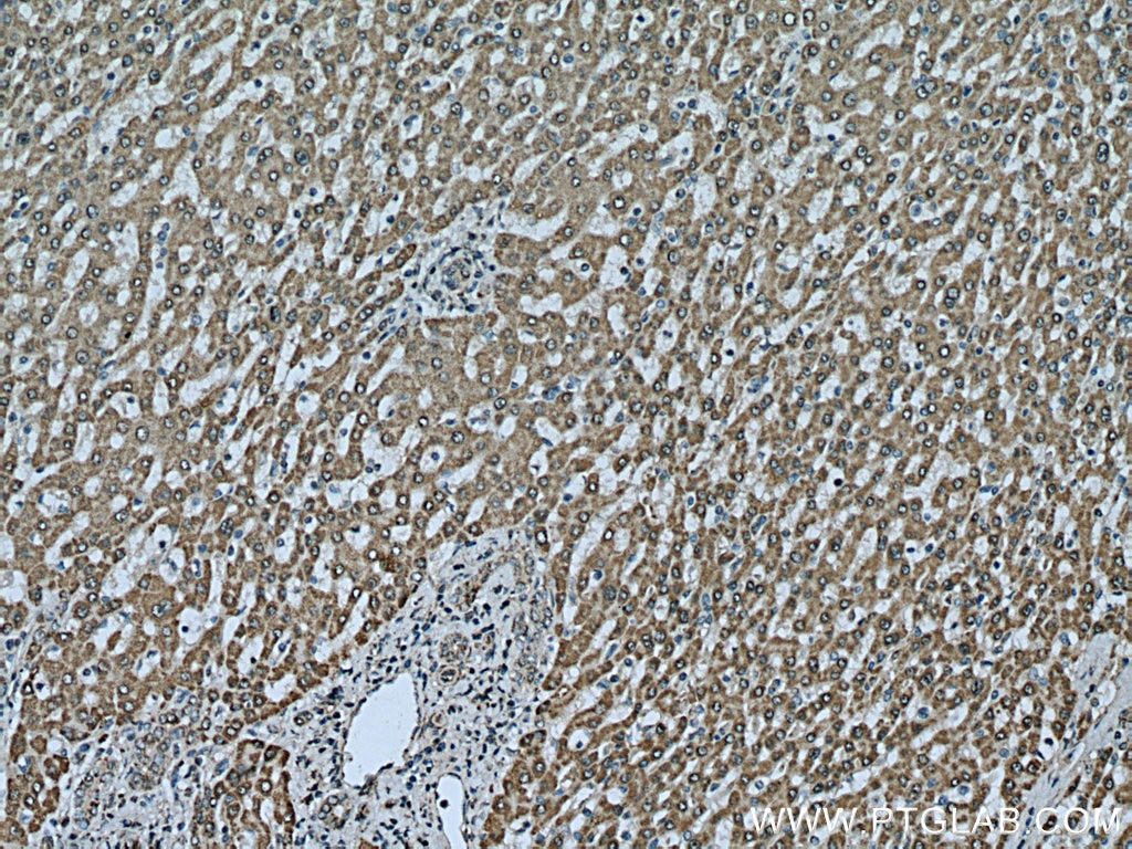 Immunohistochemistry (IHC) staining of human liver cancer tissue using PPA2 Polyclonal antibody (16662-1-AP)