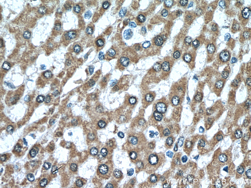 Immunohistochemistry (IHC) staining of human liver cancer tissue using PPA2 Polyclonal antibody (16662-1-AP)