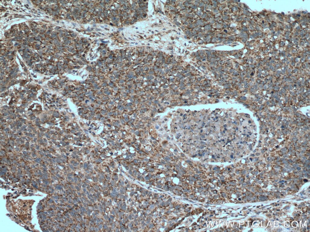 Immunohistochemistry (IHC) staining of human lung cancer tissue using PPA2 Polyclonal antibody (16662-1-AP)