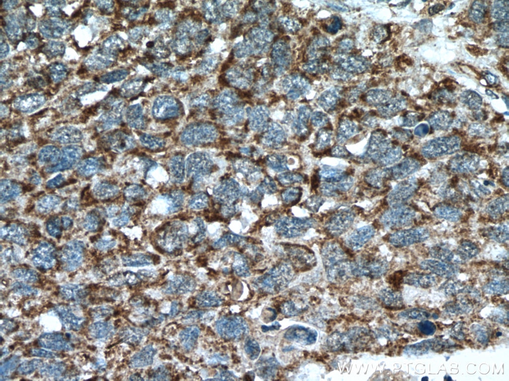 Immunohistochemistry (IHC) staining of human lung cancer tissue using PPA2 Polyclonal antibody (16662-1-AP)