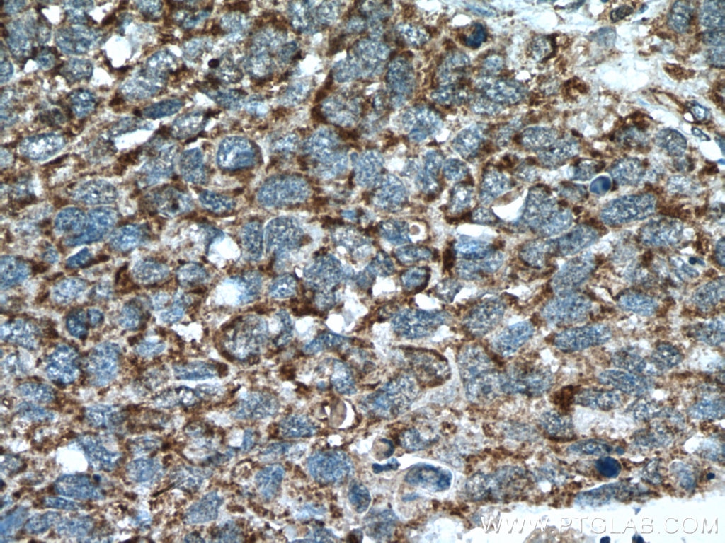 IHC staining of human lung cancer using 16662-1-AP