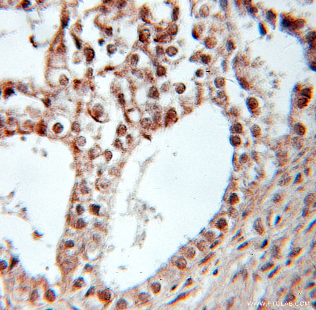 IHC staining of human ovary tumor using 10156-2-AP