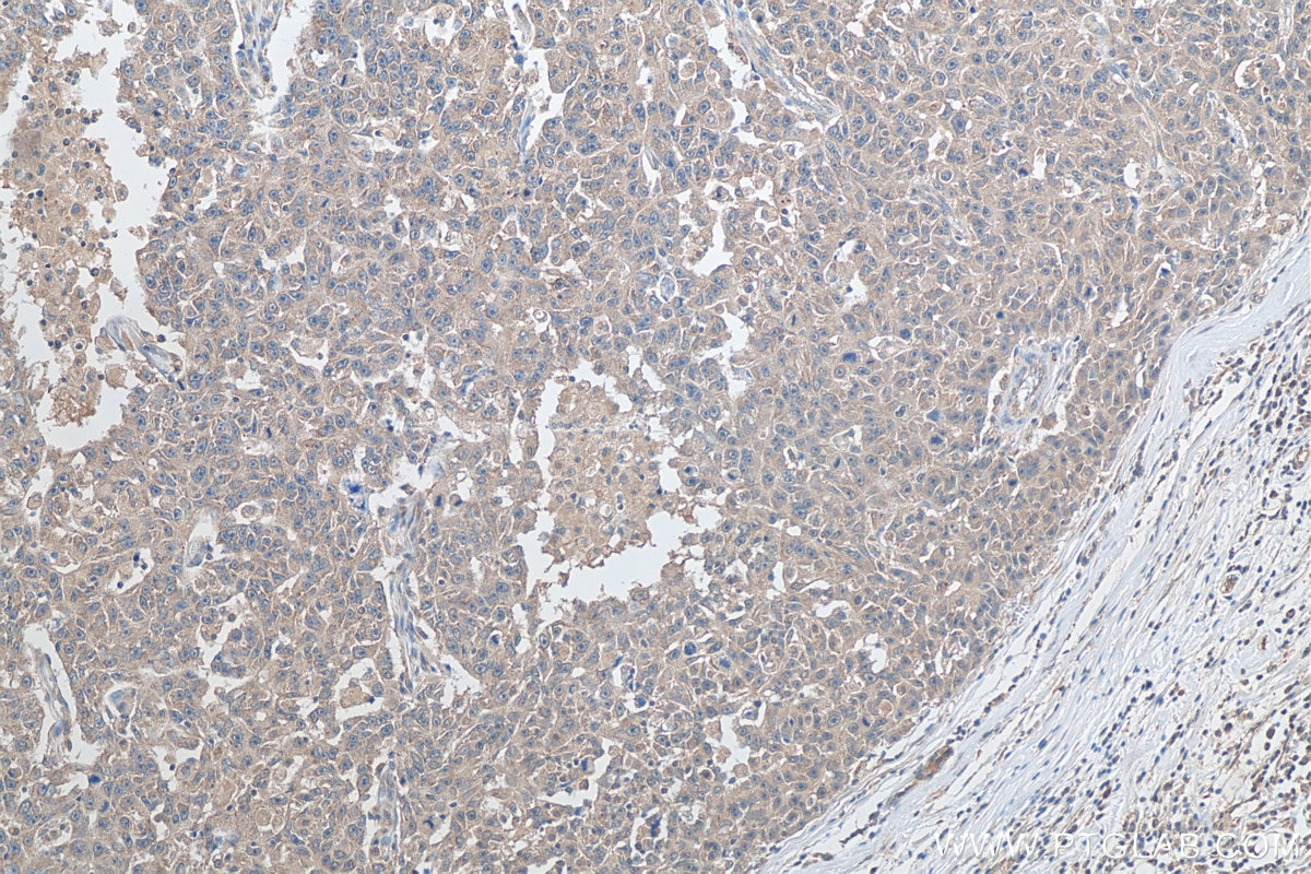 Immunohistochemistry (IHC) staining of human breast cancer tissue using PPAR Gamma Polyclonal antibody (16643-1-AP)
