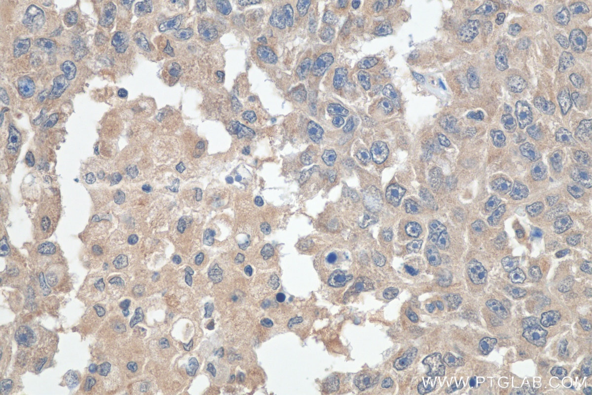 Immunohistochemistry (IHC) staining of human breast cancer tissue using PPAR Gamma Polyclonal antibody (16643-1-AP)