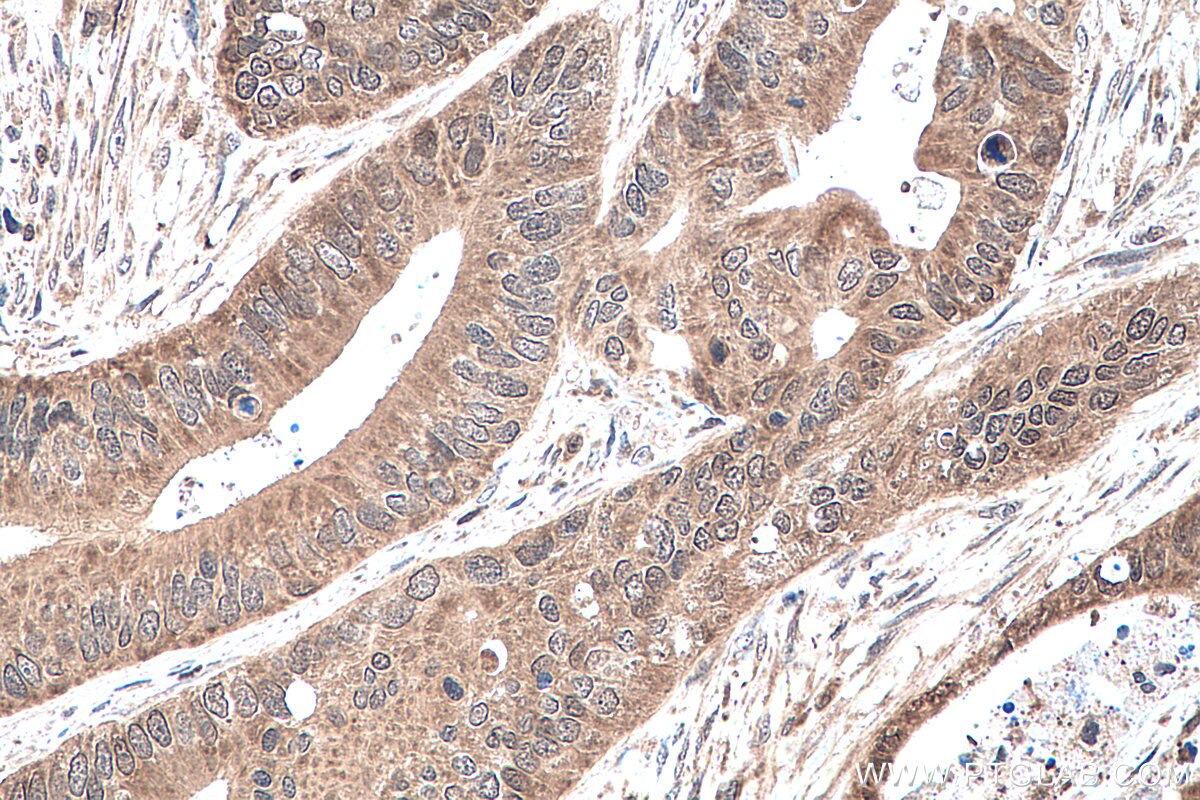 Immunohistochemistry (IHC) staining of human colon cancer tissue using PPAR Gamma Polyclonal antibody (16643-1-AP)