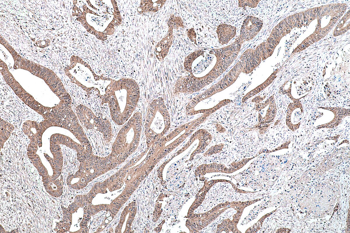 IHC staining of human colon cancer using 16643-1-AP