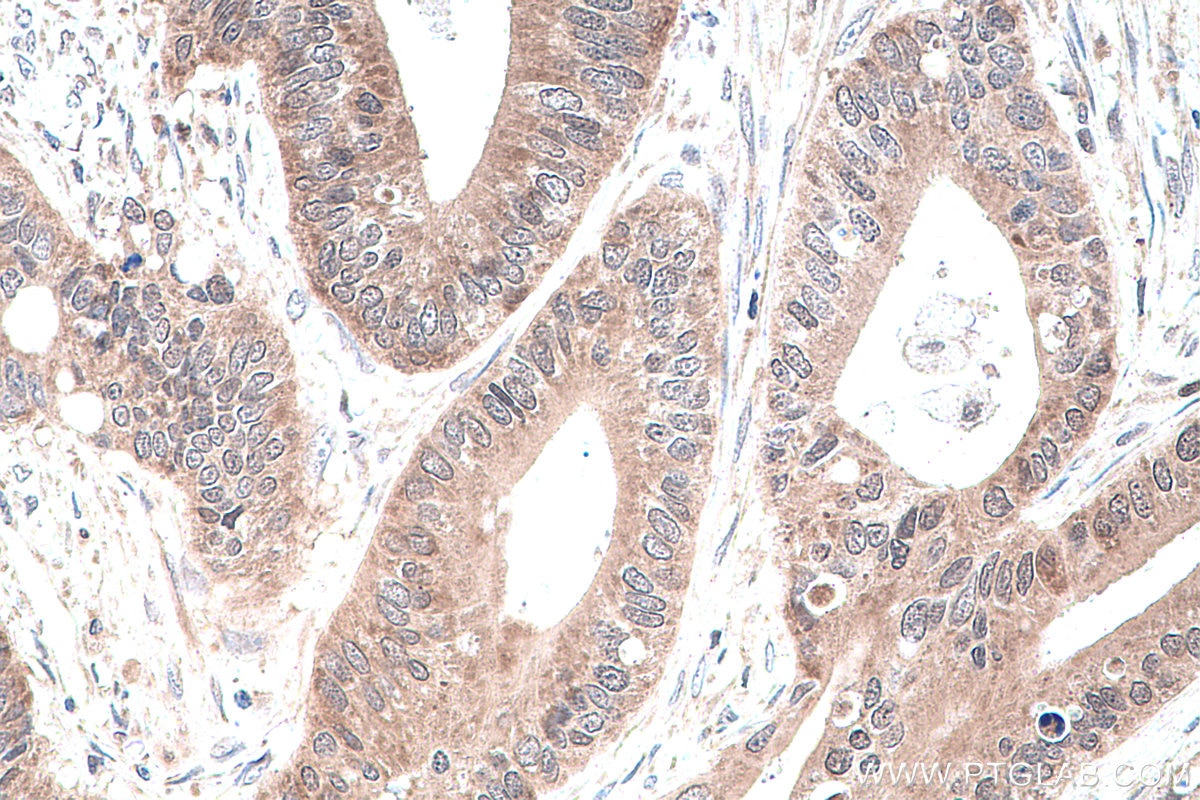 IHC staining of human colon cancer using 16643-1-AP