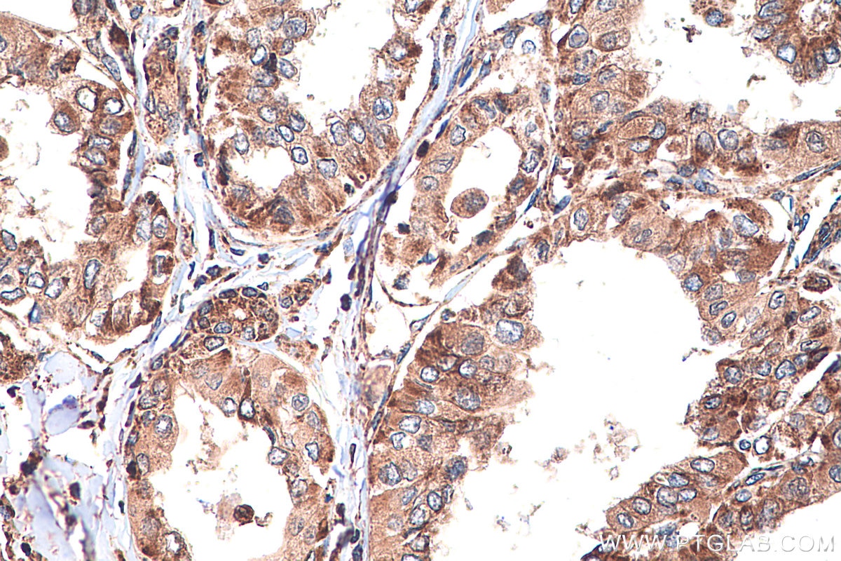 IHC staining of human thyroid cancer using 16643-1-AP