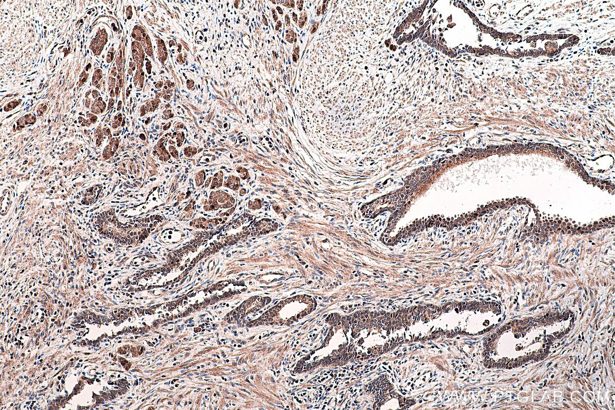 IHC staining of human prostate cancer using 16643-1-AP