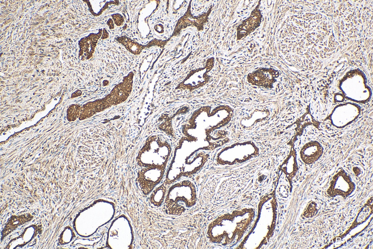 Immunohistochemistry (IHC) staining of human prostate cancer tissue using PPAR Gamma Polyclonal antibody (16643-1-AP)