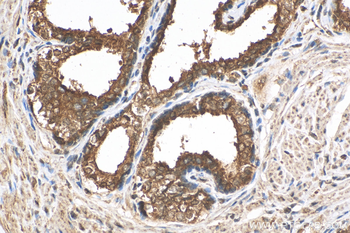 Immunohistochemistry (IHC) staining of human prostate cancer tissue using PPAR Gamma Polyclonal antibody (16643-1-AP)