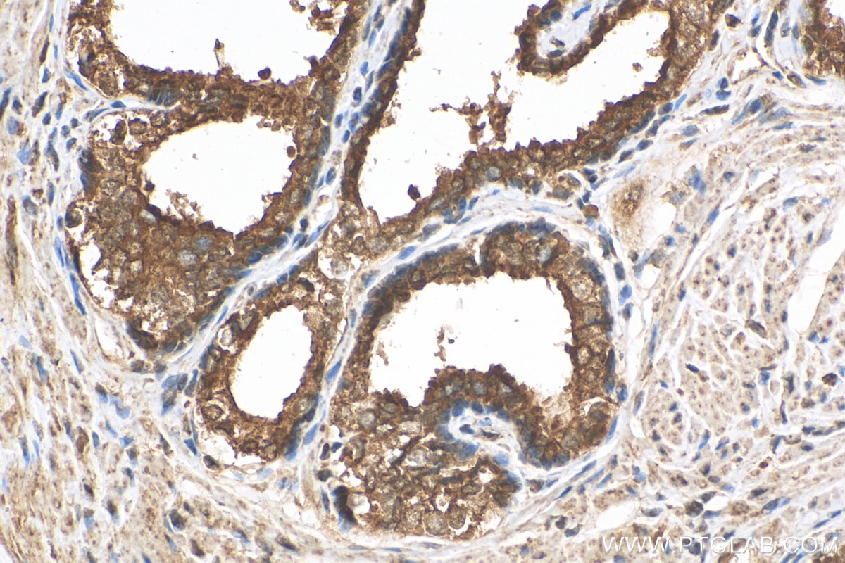 IHC staining of human prostate cancer using 16643-1-AP