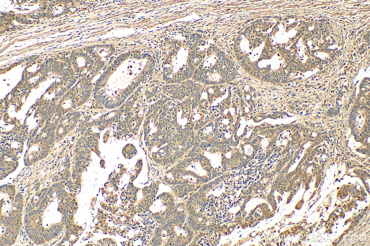 IHC staining of human colon cancer using 16643-1-AP