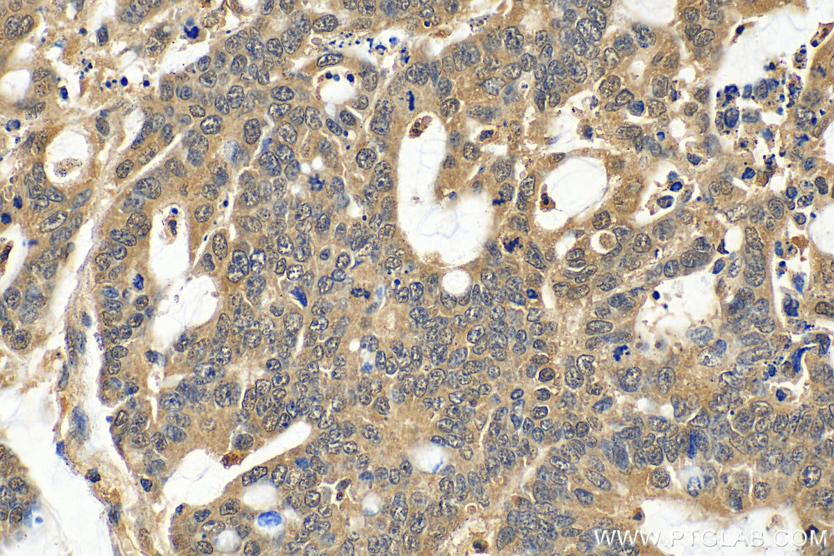 Immunohistochemistry (IHC) staining of human colon cancer tissue using PPAR Gamma Polyclonal antibody (16643-1-AP)