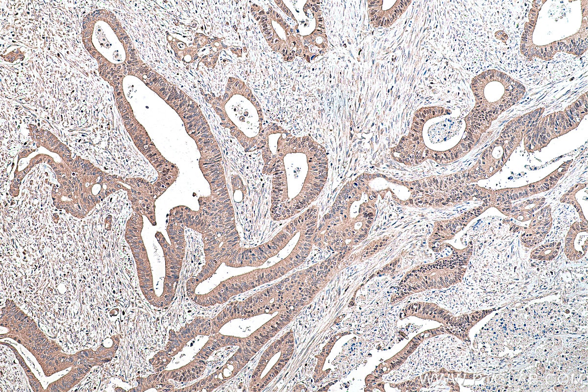 IHC staining of human colon cancer using 22061-1-AP