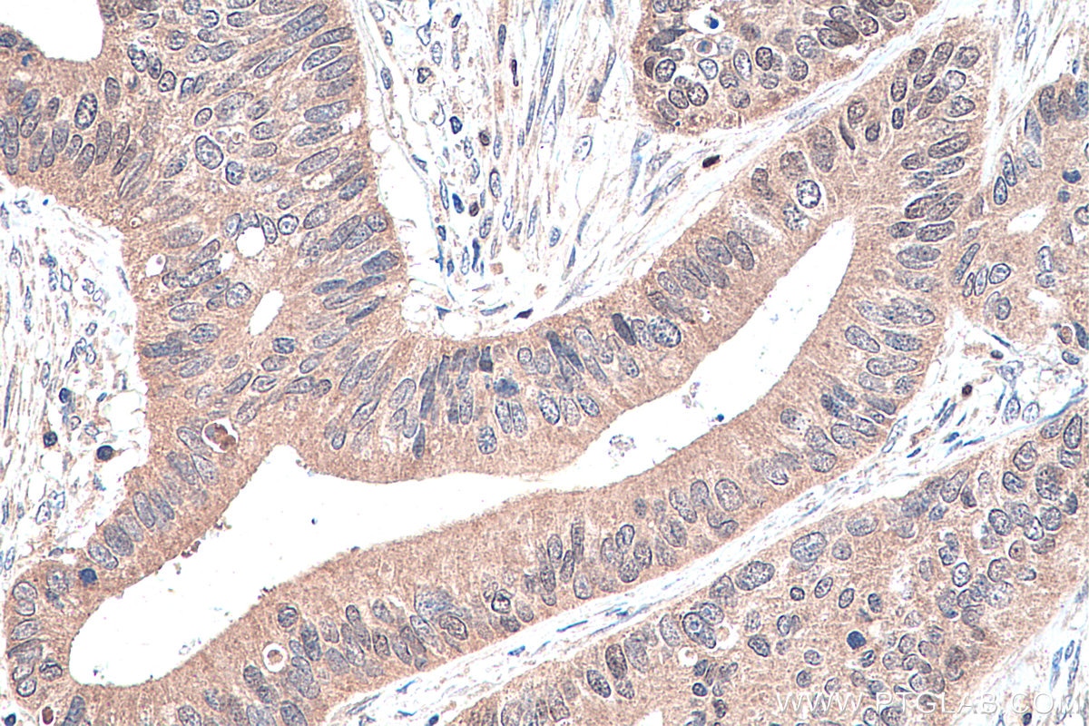 Immunohistochemistry (IHC) staining of human colon cancer tissue using PPAR Gamma Polyclonal antibody (22061-1-AP)
