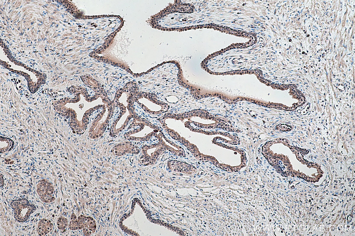Immunohistochemistry (IHC) staining of human prostate cancer tissue using PPAR Gamma Polyclonal antibody (22061-1-AP)