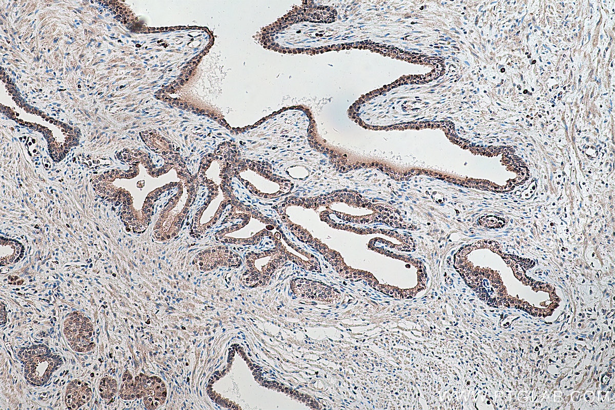 IHC staining of human prostate cancer using 22061-1-AP