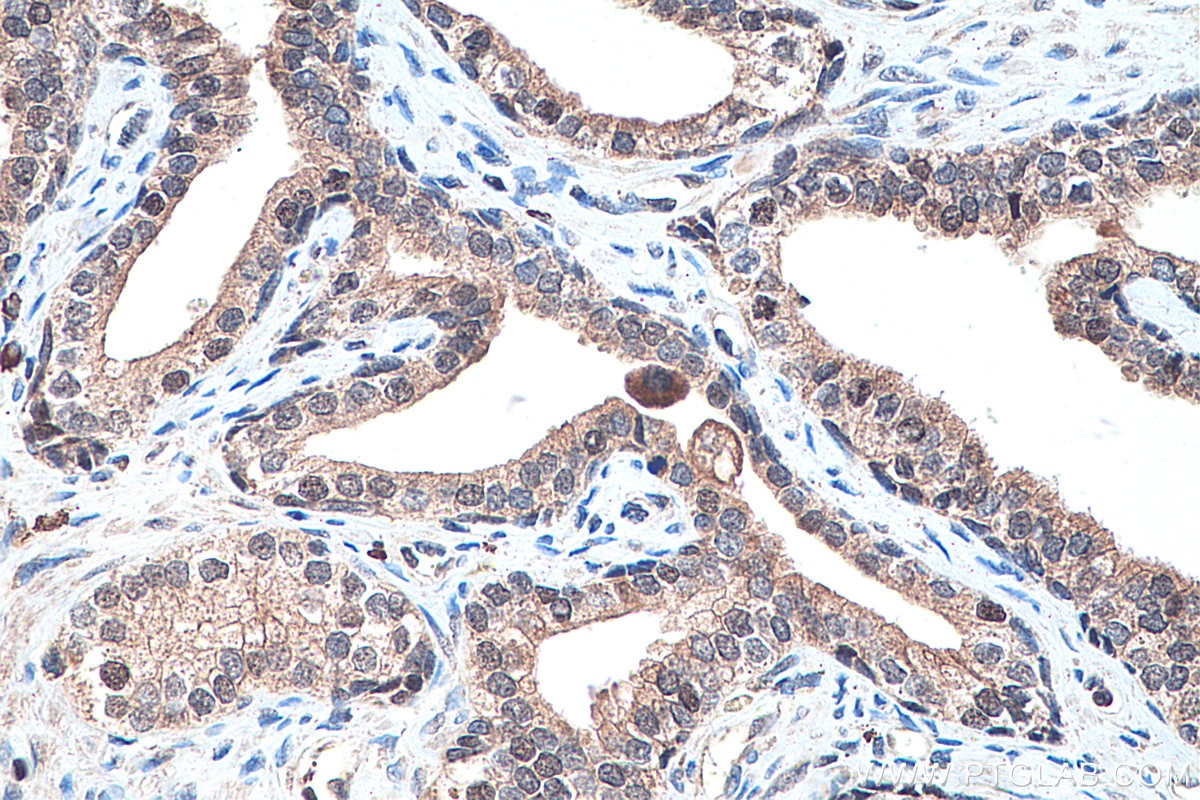 Immunohistochemistry (IHC) staining of human prostate cancer tissue using PPAR Gamma Polyclonal antibody (22061-1-AP)