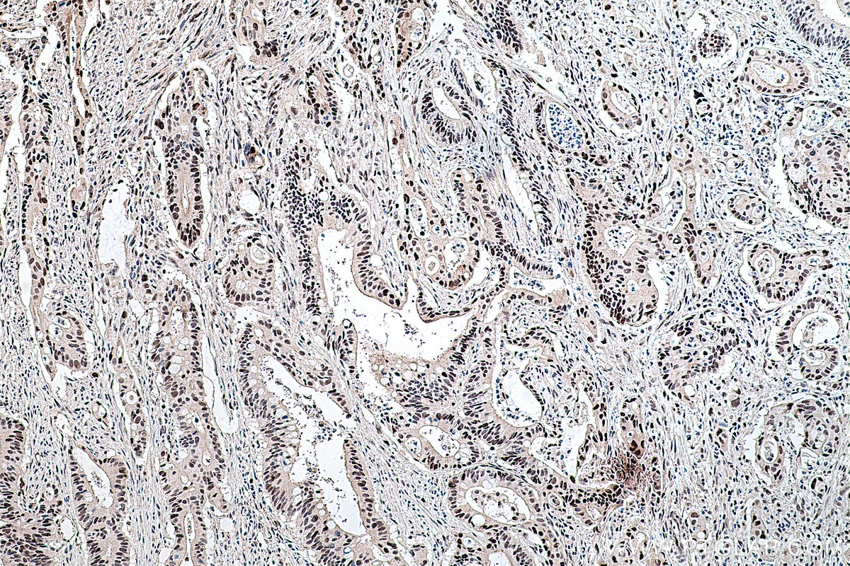 Immunohistochemistry (IHC) staining of human colon cancer tissue using PPAR Gamma Monoclonal antibody (60127-1-Ig)