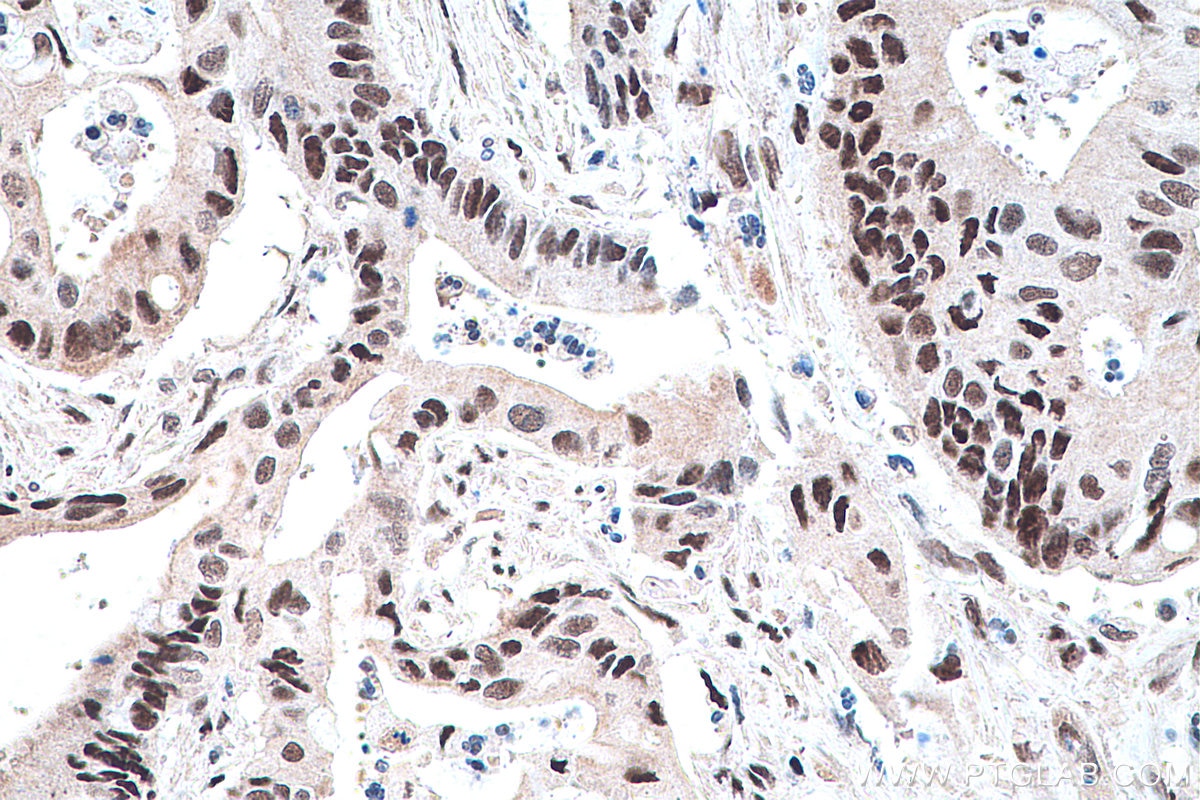 Immunohistochemistry (IHC) staining of human colon cancer tissue using PPAR Gamma Monoclonal antibody (60127-1-Ig)