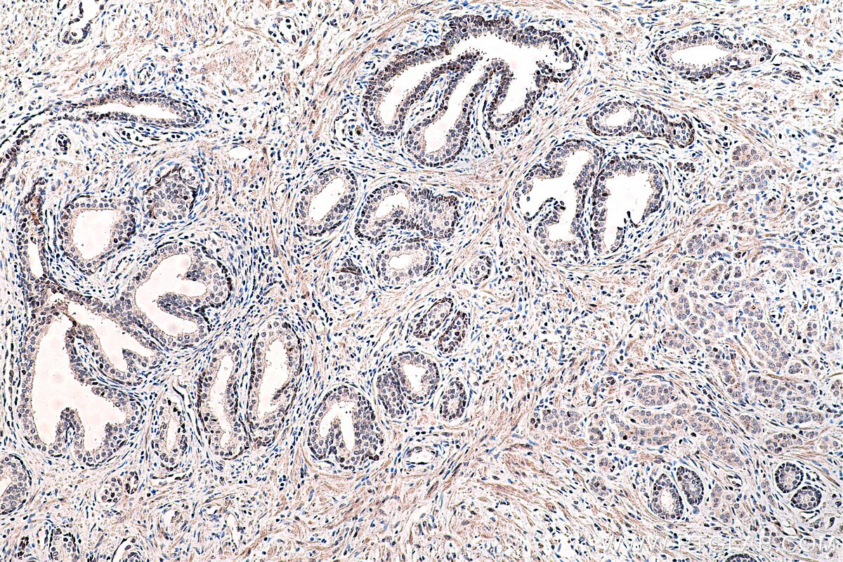 Immunohistochemistry (IHC) staining of human prostate cancer tissue using PPAR Gamma Monoclonal antibody (60127-1-Ig)