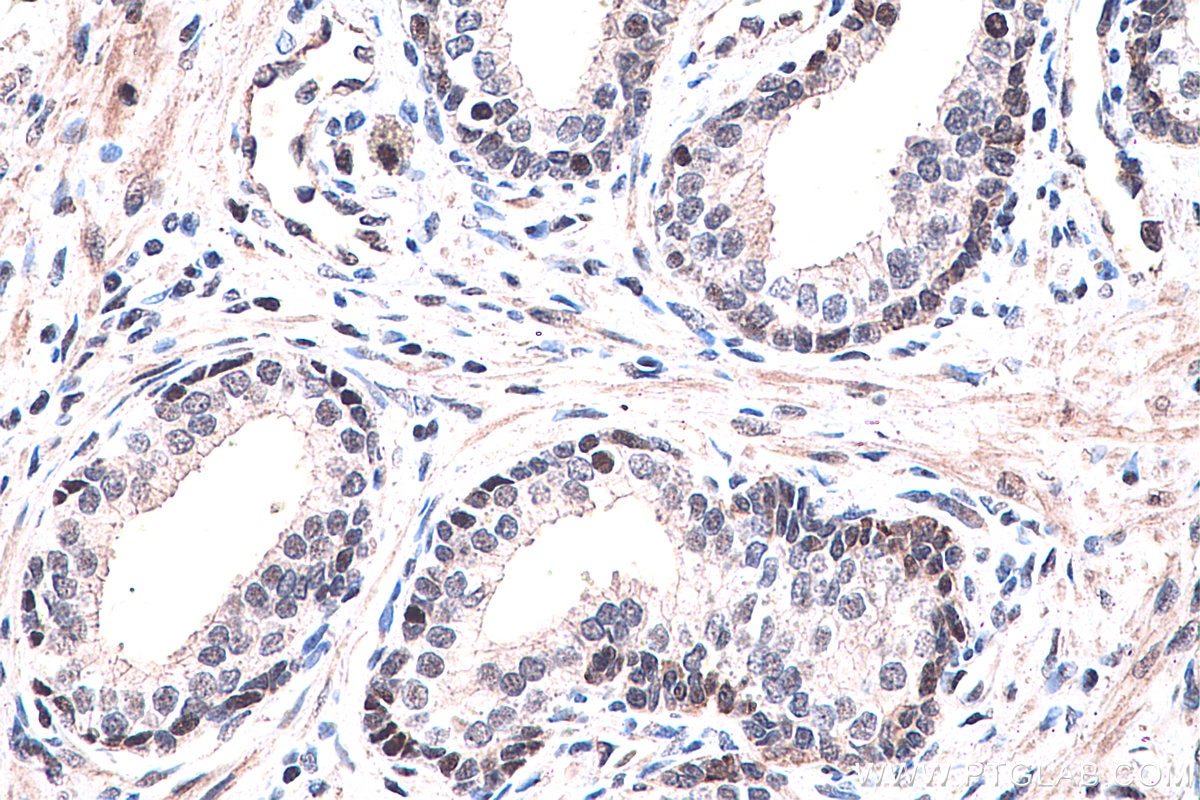 Immunohistochemistry (IHC) staining of human prostate cancer tissue using PPAR Gamma Monoclonal antibody (60127-1-Ig)