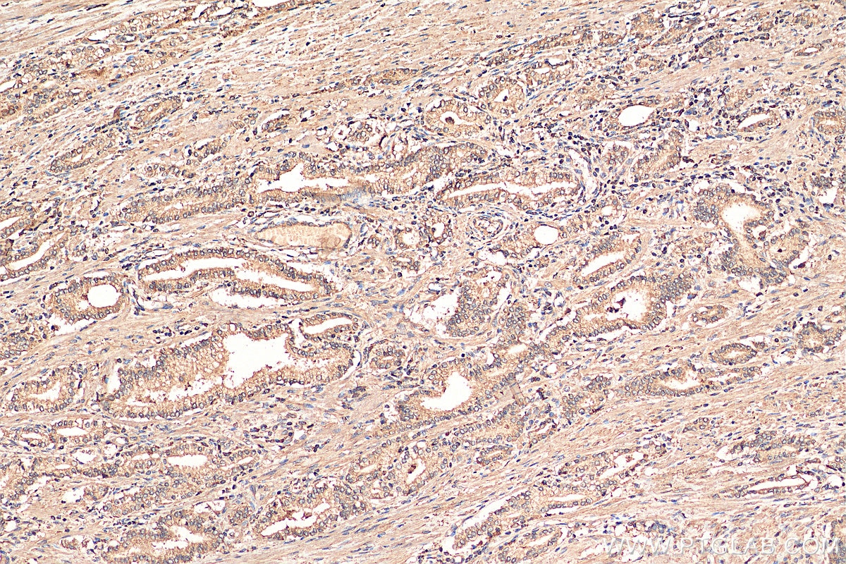 IHC staining of human prostate cancer using 66936-1-Ig