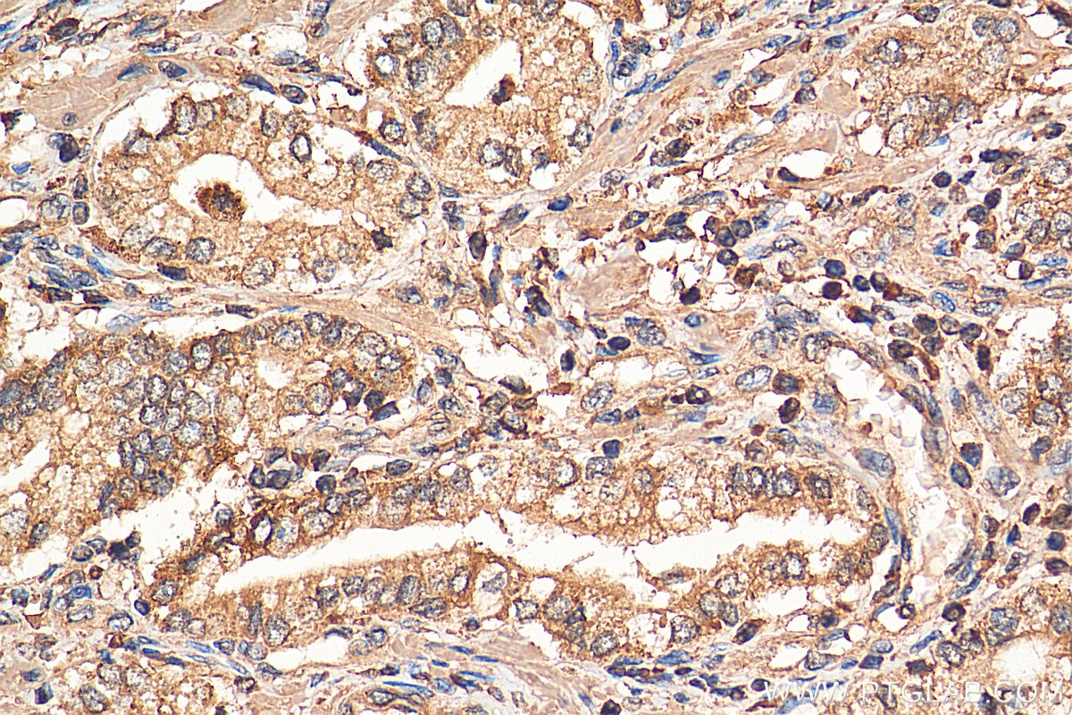 Immunohistochemistry (IHC) staining of human prostate cancer tissue using PPAR Gamma Monoclonal antibody (66936-1-Ig)