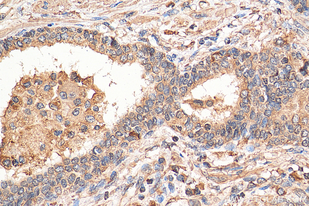 Immunohistochemistry (IHC) staining of human prostate cancer tissue using PPAR Gamma Monoclonal antibody (66936-1-Ig)