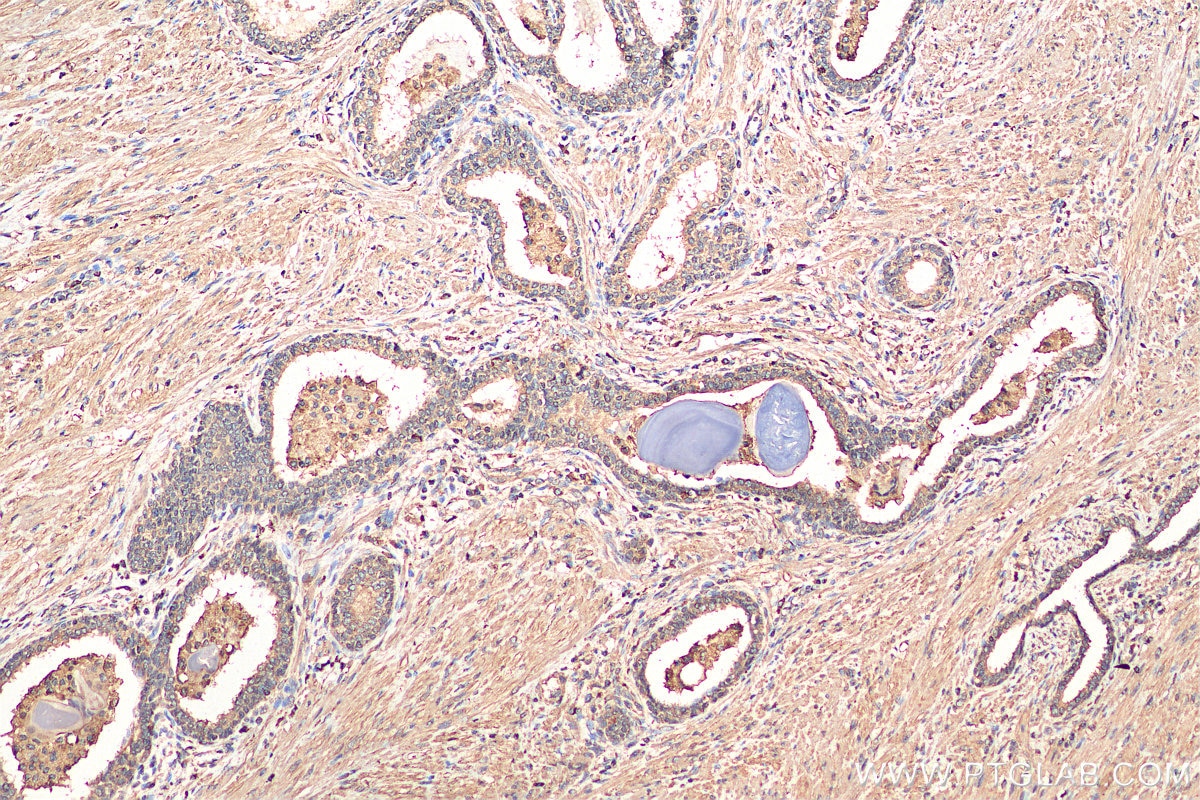 Immunohistochemistry (IHC) staining of human prostate cancer tissue using PPAR Gamma Monoclonal antibody (66936-1-Ig)