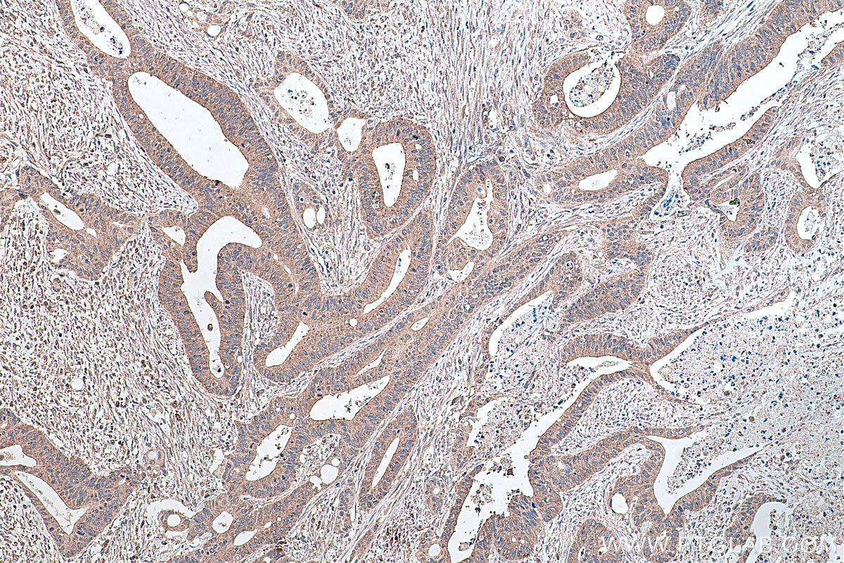 Immunohistochemistry (IHC) staining of human colon cancer tissue using PPAR Gamma Monoclonal antibody (66936-1-Ig)