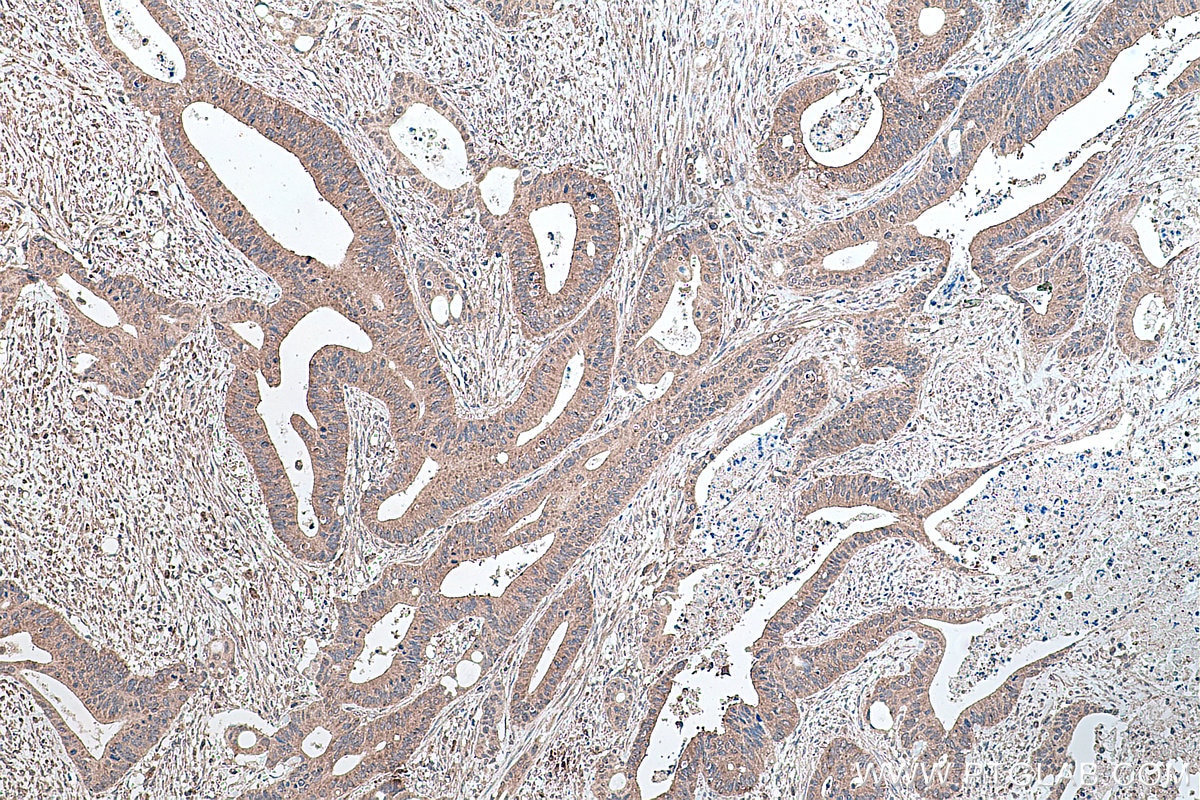 IHC staining of human colon cancer using 66936-1-Ig