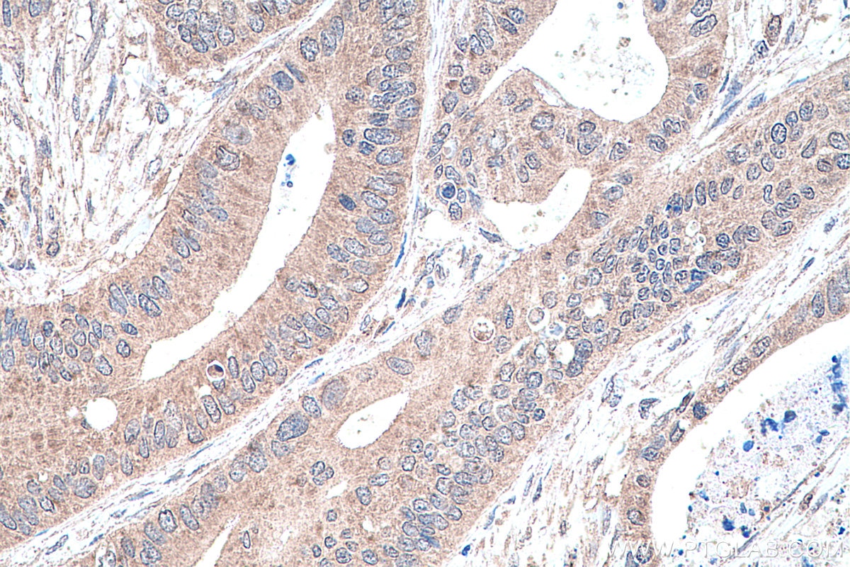 IHC staining of human colon cancer using 66936-1-Ig