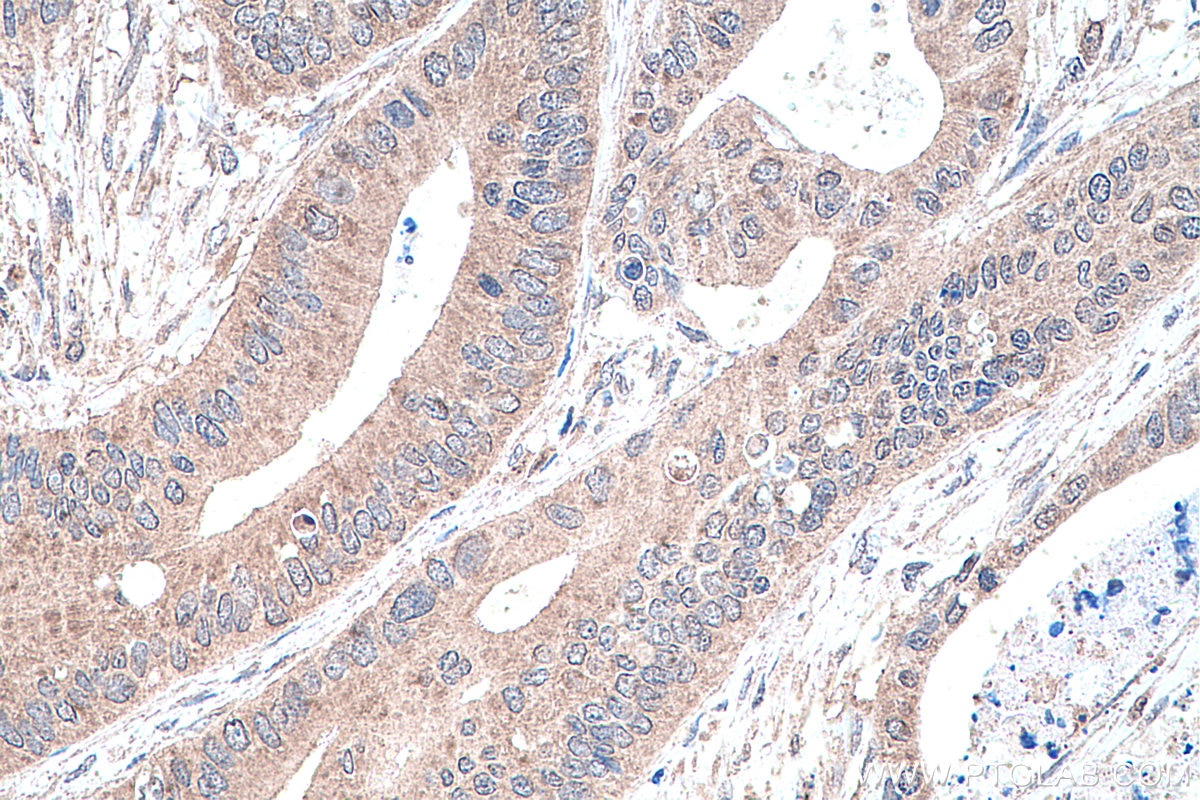 Immunohistochemistry (IHC) staining of human colon cancer tissue using PPAR Gamma Monoclonal antibody (66936-1-Ig)