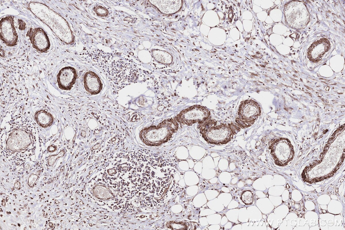 IHC staining of human colon cancer using 85096-1-RR Immunohistochemistry (IHC) staining of human colon cancer tissue using PPAT Recombinant monoclonal antibody (85096-1-RR)