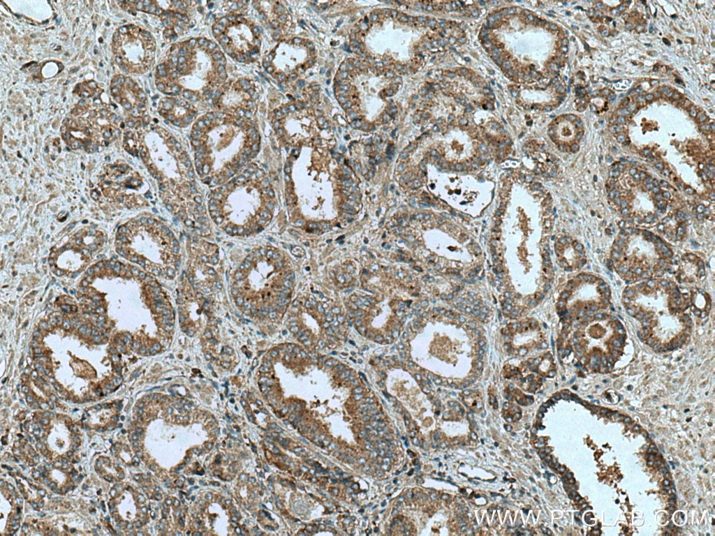 Immunohistochemistry (IHC) staining of human prostate cancer tissue using Liprin Alpha 1 Polyclonal antibody (14175-1-AP)