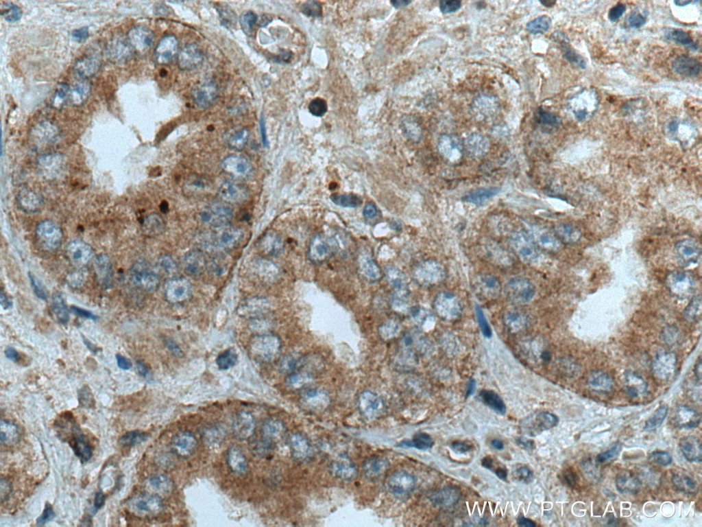 Immunohistochemistry (IHC) staining of human prostate cancer tissue using Liprin Alpha 1 Polyclonal antibody (14175-1-AP)