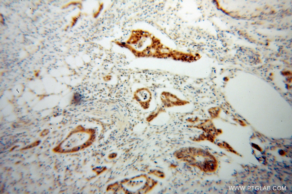 Immunohistochemistry (IHC) staining of human colon cancer tissue using PPFIBP1 Polyclonal antibody (13961-1-AP)