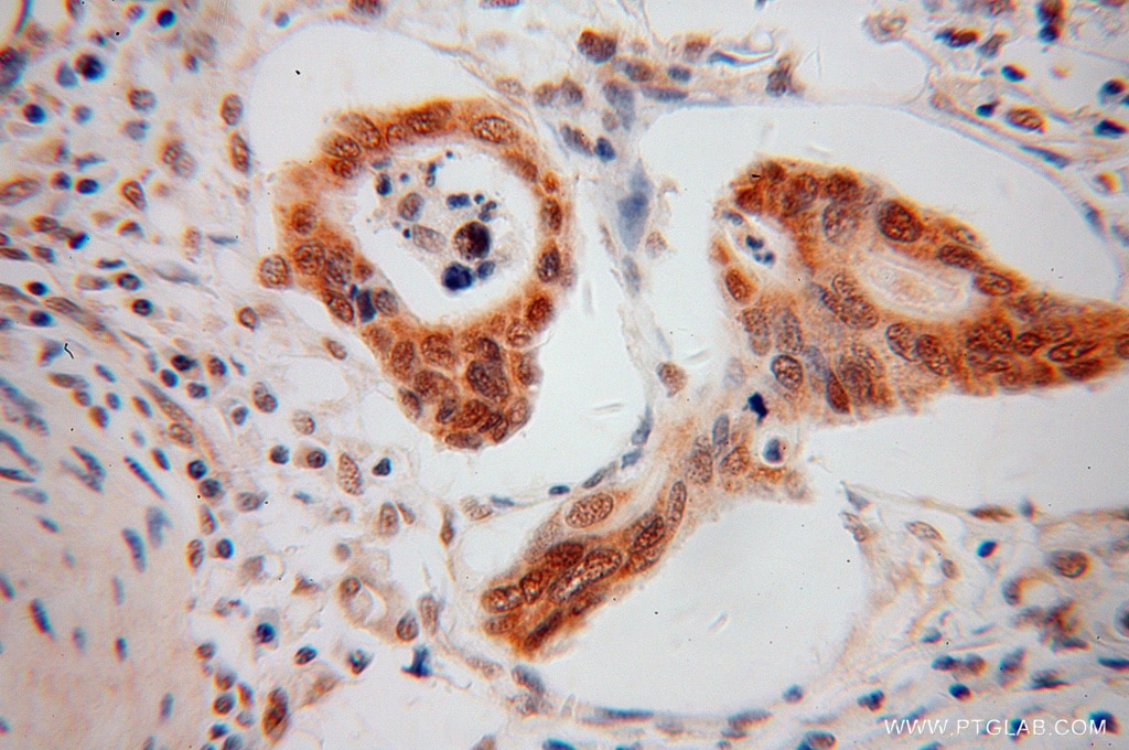 Immunohistochemistry (IHC) staining of human colon cancer tissue using PPFIBP1 Polyclonal antibody (13961-1-AP)