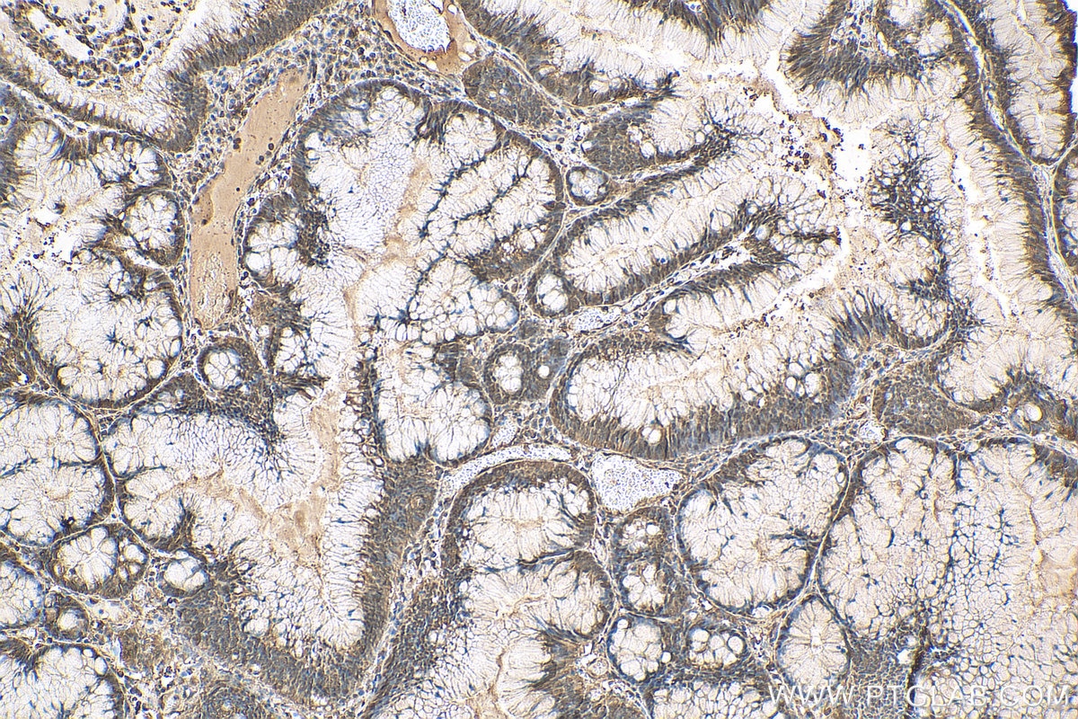 IHC staining of human colon cancer using 10720-1-AP