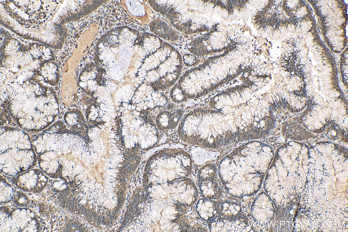 Immunohistochemistry (IHC) staining of human colon cancer tissue using Cyclophilin A Polyclonal antibody (10720-1-AP)