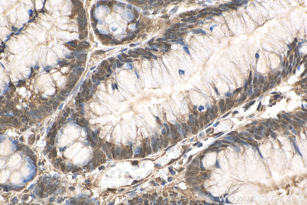 IHC staining of human colon cancer using 10720-1-AP