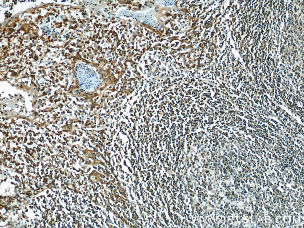 Immunohistochemistry (IHC) staining of human tonsillitis tissue using Cyclophilin A Polyclonal antibody (10720-1-AP)